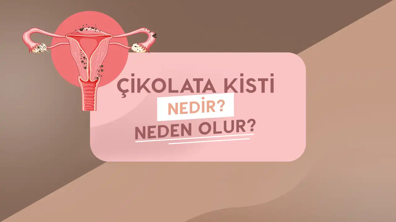 cikolata kisti nedir neden olur