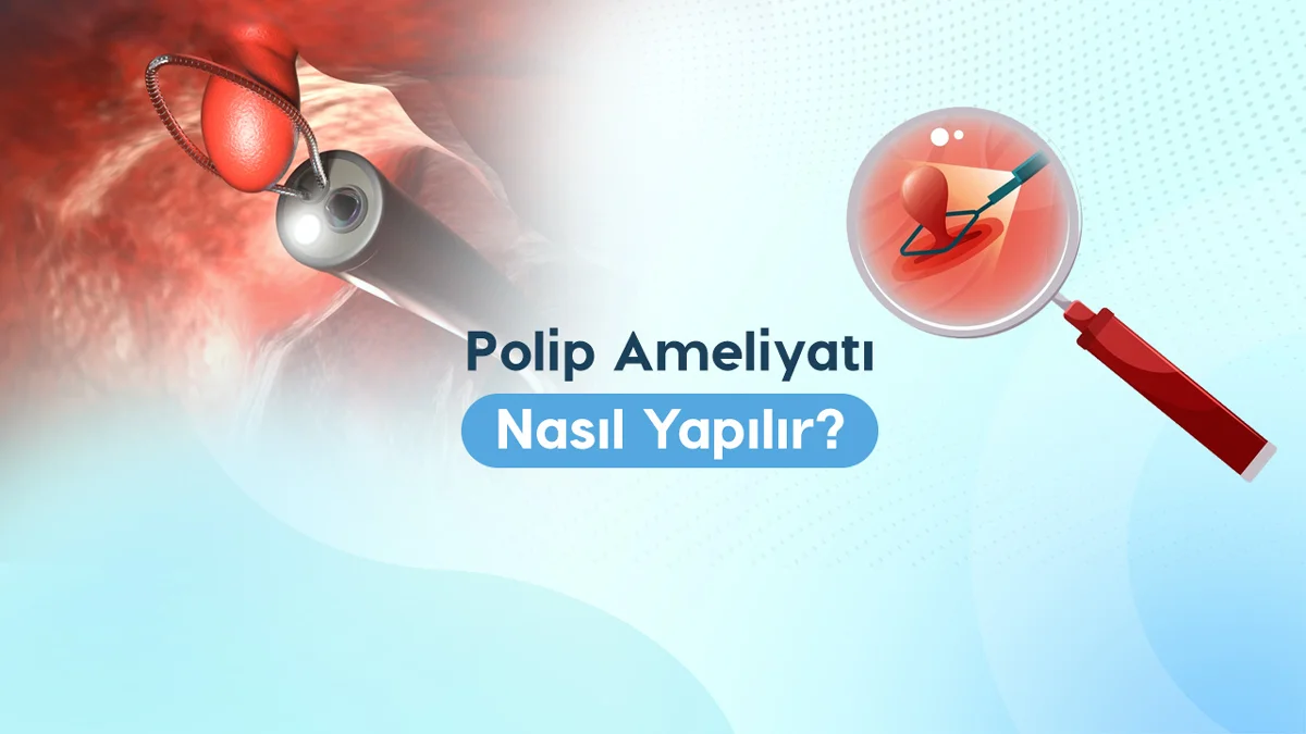 Polip ameliyatı sırasında histeroskopla rahim içindeki polipin çıkarılmasını gösteren görsel
