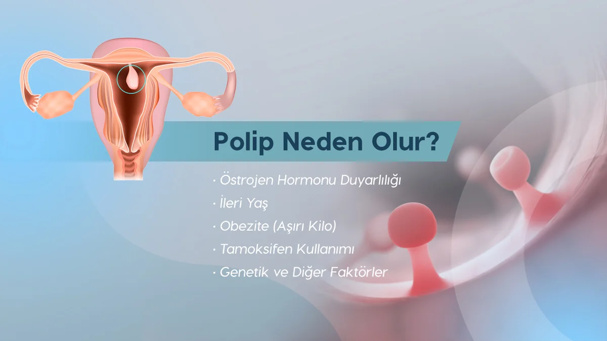 Polip ameliyatı gerektirebilen rahim içi poliplerin nedenlerini sıralayan rahim çizimi